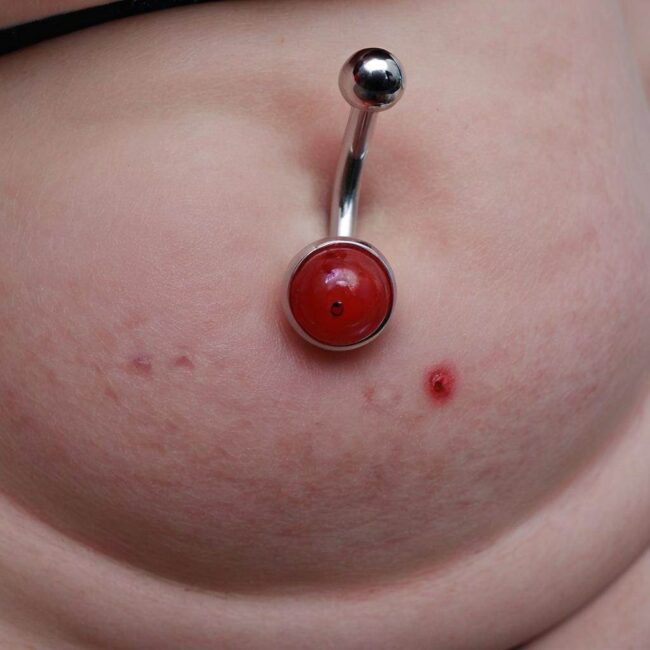 Jak leczyć zaczerwienienie przy kolczyku w pępku